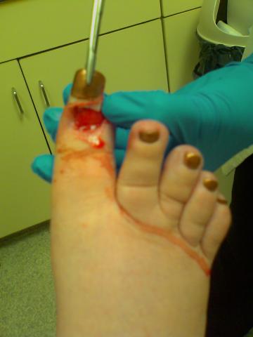 here we go, here is the toenail that the doc just finished removing the rest 